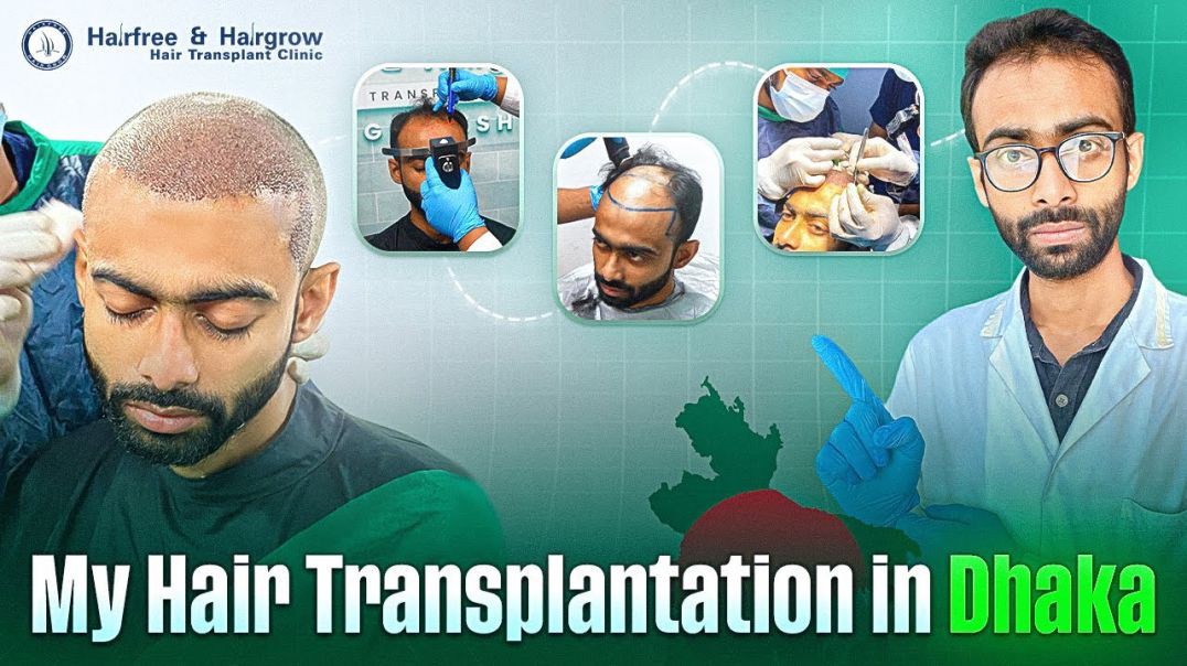 ⁣⁣আমার Hair Transplant এর Step by Step প্রসেস। বাংলাদেশে কেন করলাম